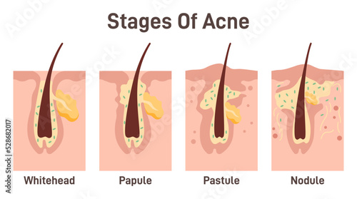 Acne development stages. Inflamed skin pimples. Plugged hair follicles
