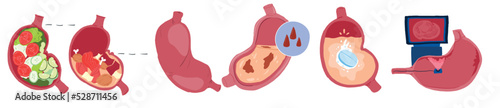 Set of different states of a sick and healthy stomach, proper nutrition and diagnosis. Vector flat cartoon illustration icon. Isolated on white background. Stomach feeling cartoon concept