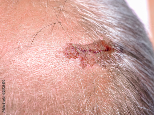 Bloody scar on a man's head © Elroi