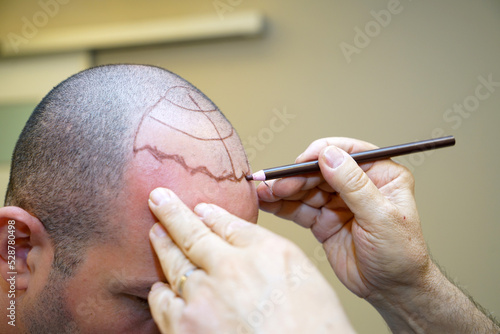 Tableau sur toile The man without hair is skin marked by the doctor at the hair transplant center for the place to be transplanted