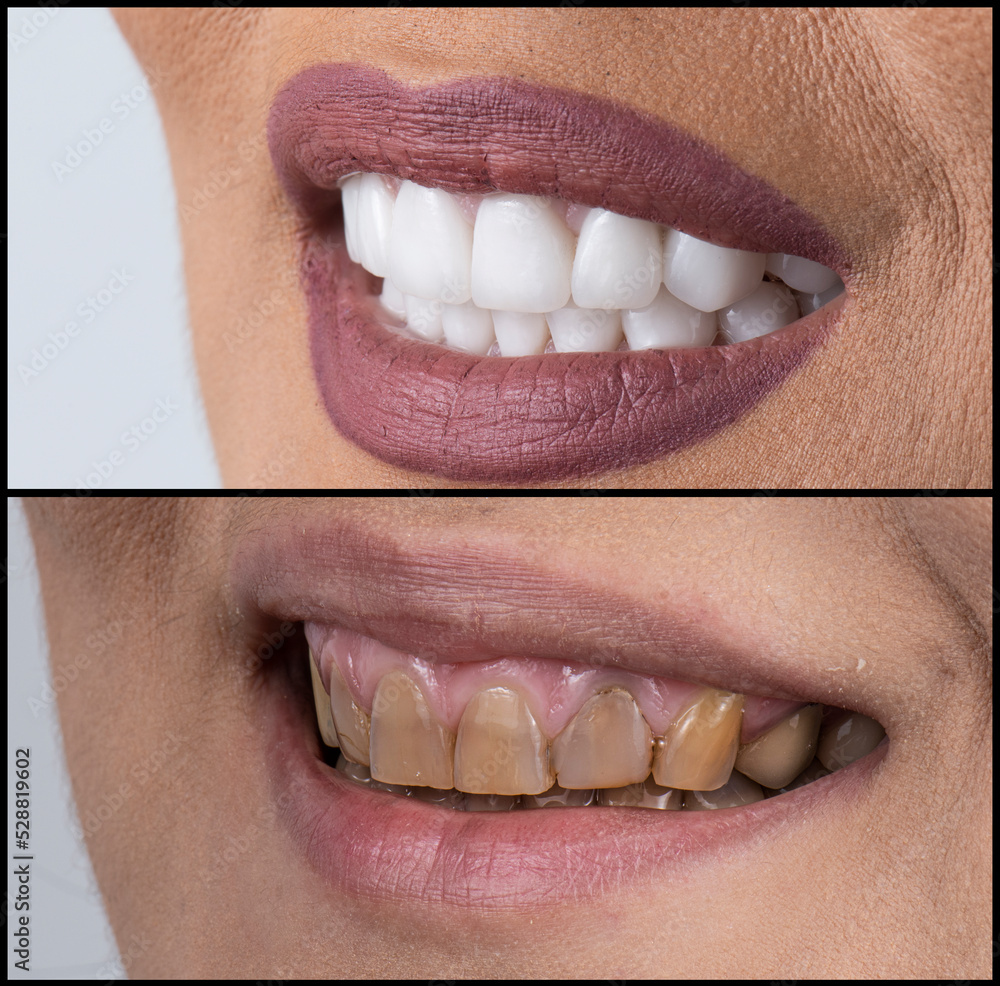 Fototapeta premium dental job photography, crowns veneers implants