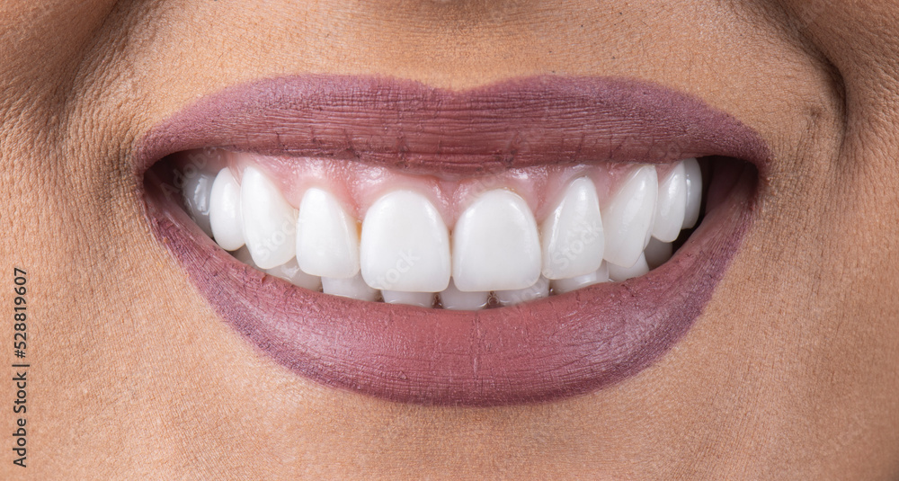 Fototapeta premium dental job photography, crowns veneers implants