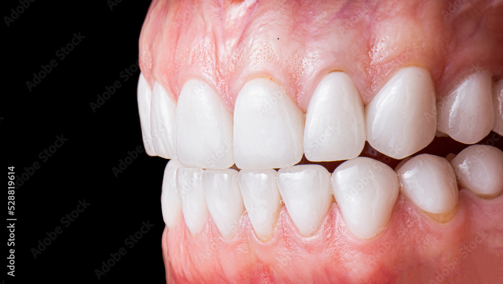 Obraz premium dental job photography, crowns veneers implants