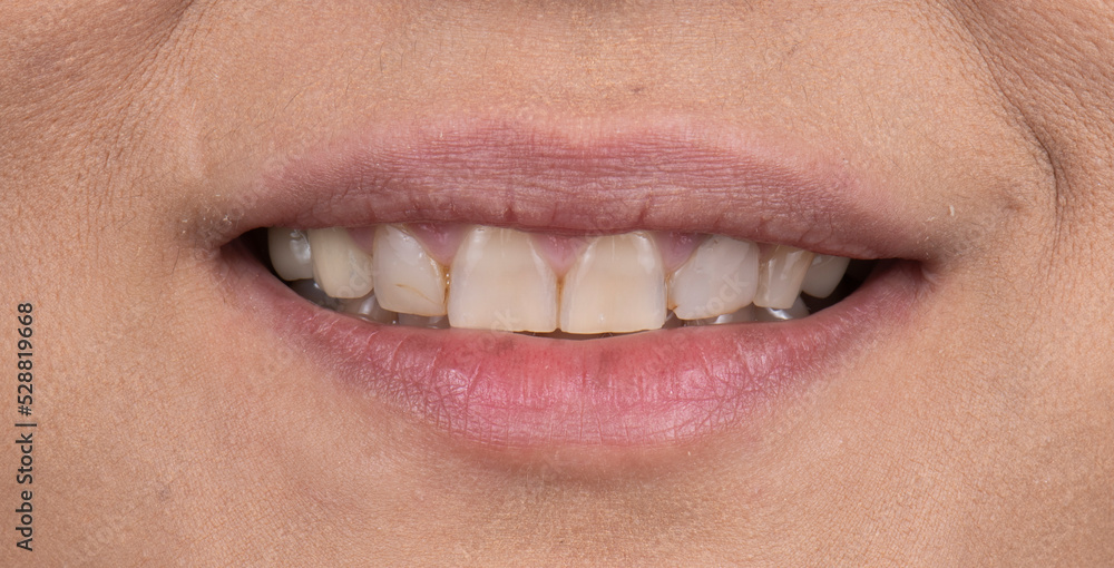 Obraz premium dental job photography, crowns veneers implants