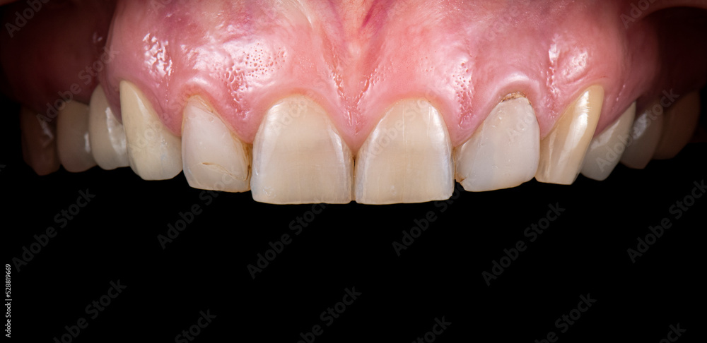 Obraz premium dental job photography, crowns veneers implants
