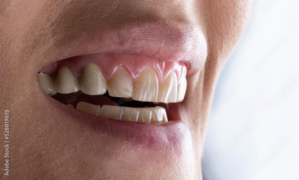Obraz premium dental job photography, crowns veneers implants