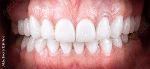 dental job photography, crowns veneers implants