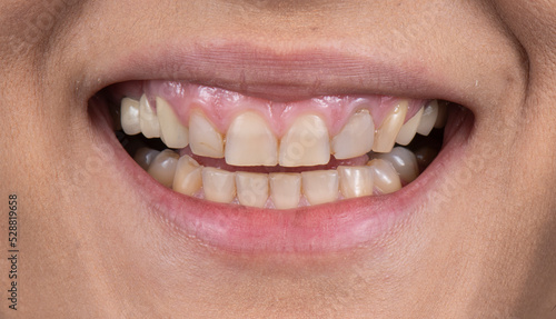 dental job photography, crowns veneers implants