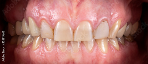 dental job photography, crowns veneers implants