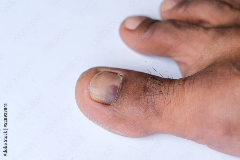 Fototapeta premium Toenail cuts and bruises. Concept illustration of the need for health care, pedology or dermatology