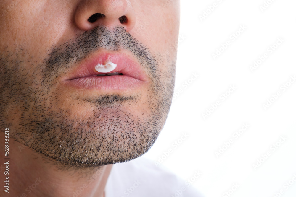 Obraz premium medical treatment with cold sore cream on a man's anonymous face