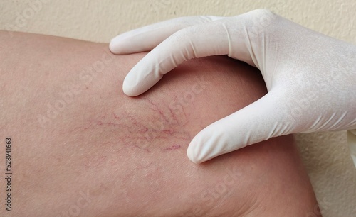 Portrait showing the hand holding the flabbiness skin and varicose veins on the leg, circulation of blood, problem wrinkle and inflammation skin of the patient woman, concept health care.