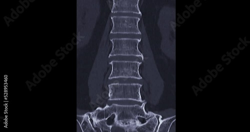 CT myelography or myelogram from computed tomography (CT-scanner) to look for problems in the spinal canal. photo