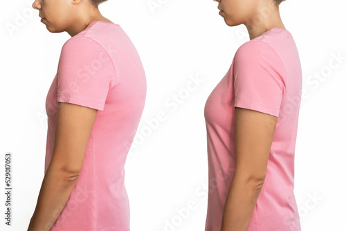 A young woman before and after treatment of scoliosis isolated on a white background. Correct and incorrect spine position. Slouching back and healthy spine. A posture before and after changing