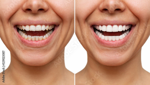 Cropped shot of a young caucasian smiling woman before and after veneers  installation isolated on a white background. Teeth whitening. Dentistry  dental treatment