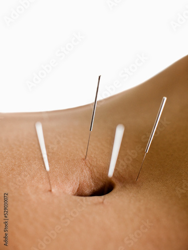 Woman Receiving Acupuncture. Koh Samui, Thailand.