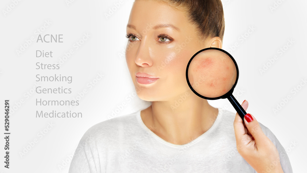 Post-Acne Marks /Treating Acne Scars.Acne Scar Removal. Post-Acne Marks /Treating Acne Scars.Acne Scar Removal.