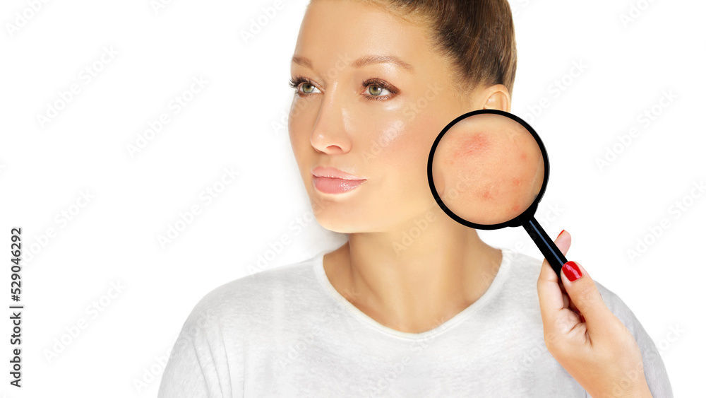 Post-Acne Marks /Treating Acne Scars.Acne Scar Removal. Post-Acne Marks /Treating Acne Scars.Acne Scar Removal.