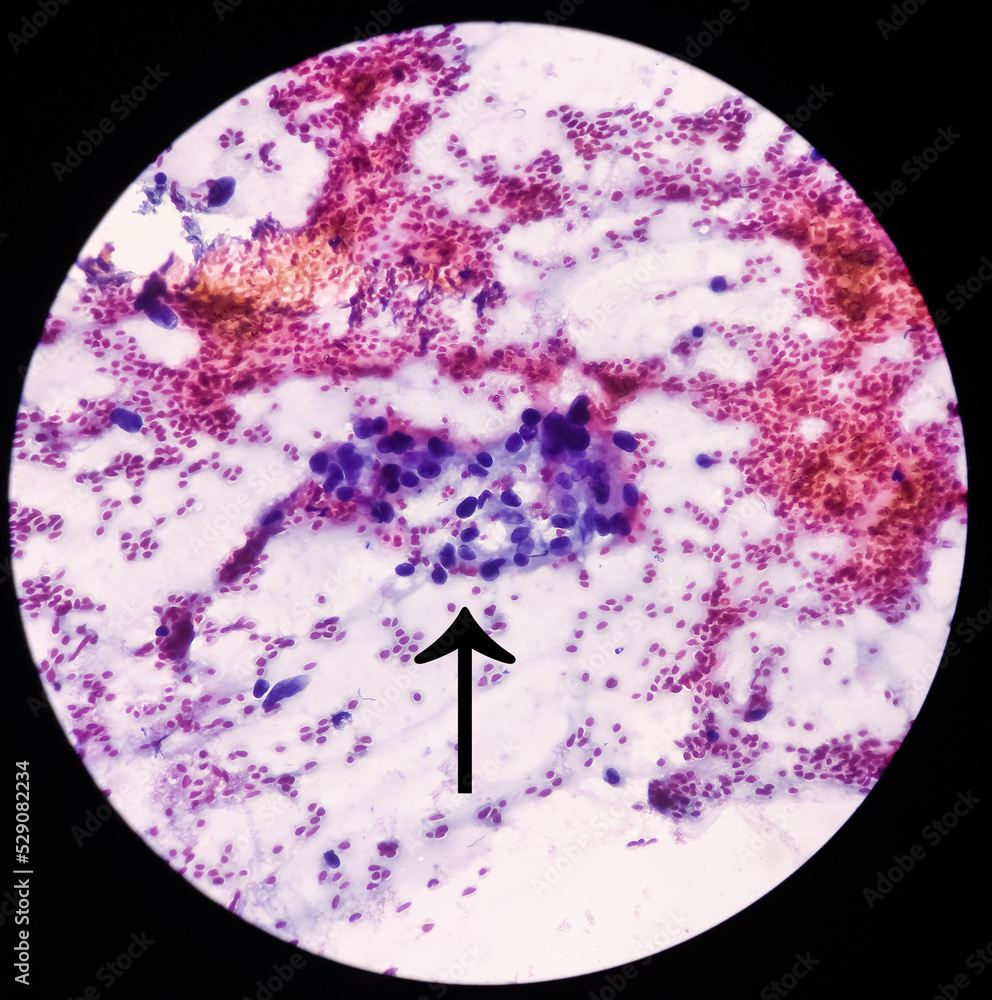 Intra abdominal mass(Cytology) Spindle cell positive