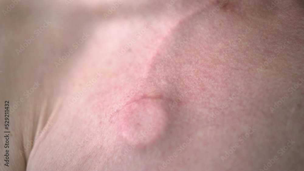 Close-up of a catheter under the skin. An elderly man has a chemotherapy catheter in his neck. Close-up of a catheter under the skin. An elderly man has a chemotherapy catheter in his neck.