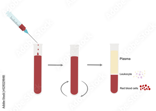 The peripheral or whole blood were centrifuged and separated the important 3 layers: plasma, leukocyte or white blood cells, red blood cells or erythrocyte for target detection or specific diagnosis.