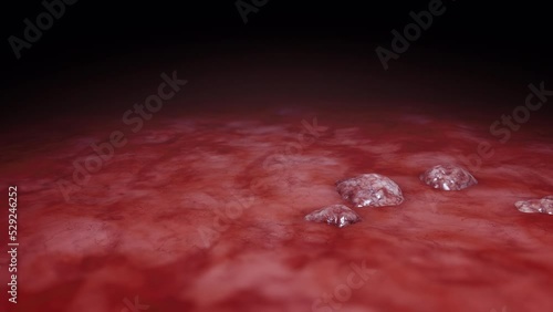Cancer cell growth animation. Tumor growing and spreading over healthy tissue causing inflammation and metastasis.  photo