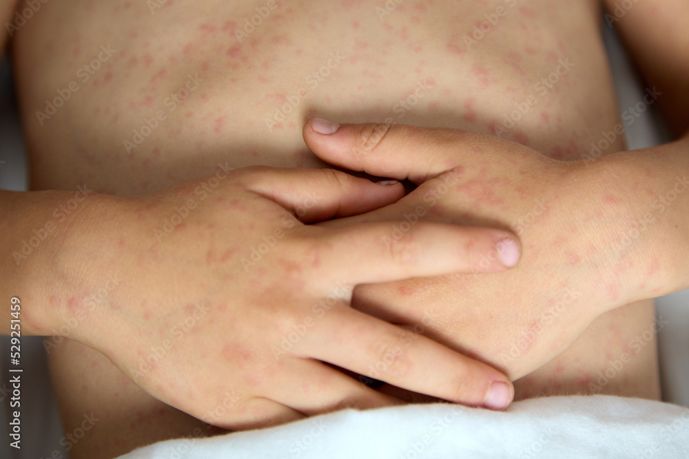 Close-up of the hands of a child with rubella, folded on the stomach. A child with chickenpox lies on his back, folded his hands on his stomach Close-up of the hands of a child with rubella, folded on the stomach. A child with chickenpox lies on his back, folded his hands on his stomach