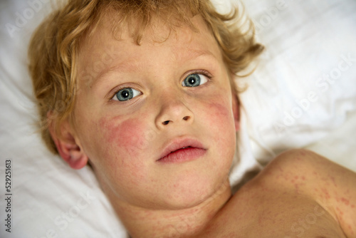 Face of a cute boy lying in bed and suffering from a serious illness on the skin. A strong allergic reaction in the form of a rash covered the entire body and face of the child