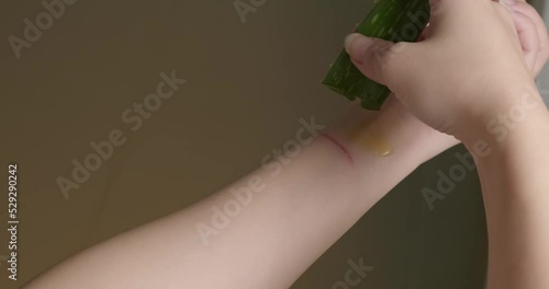 Closeup blisters, Female Applying Aloe Vera on her Palm Moisturizing and Caring for her Skin. using Aloe Vera on treat fire burns in skin - heat burn wound on hand caused by hot cooking oil spill. 