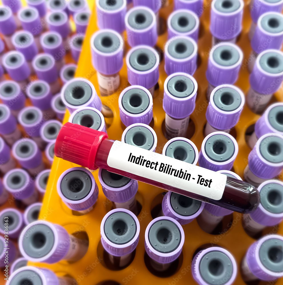 Blood sample for Indirect Bilirubin(unconjugated bilirubin) test, liver