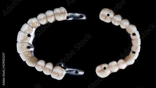 excellent dental composition of two prostheses made of titanium and ceramics, top view on a black background