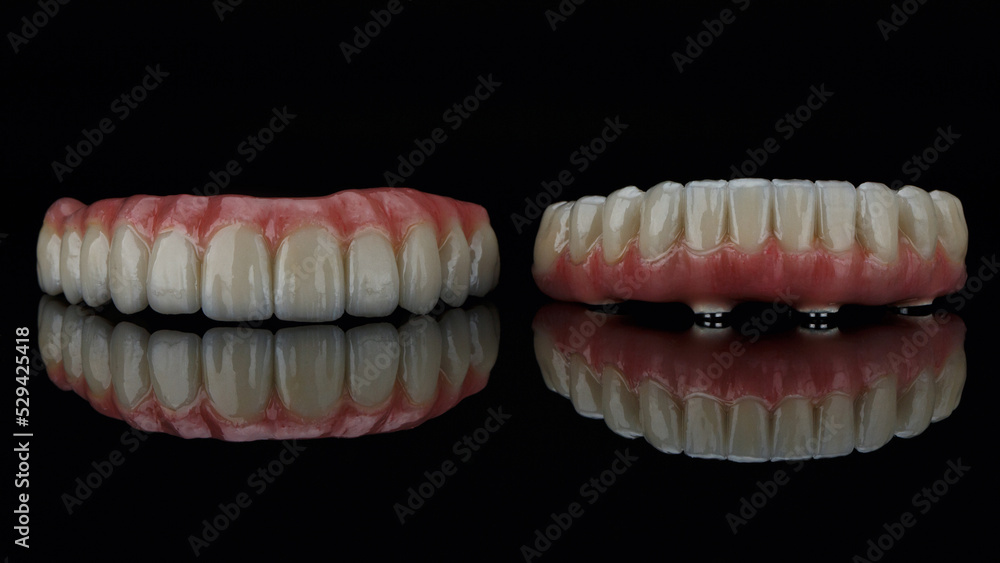 two excellent dental prostheses with gums on black glass and reflection two excellent dental prostheses with gums on black glass and reflection