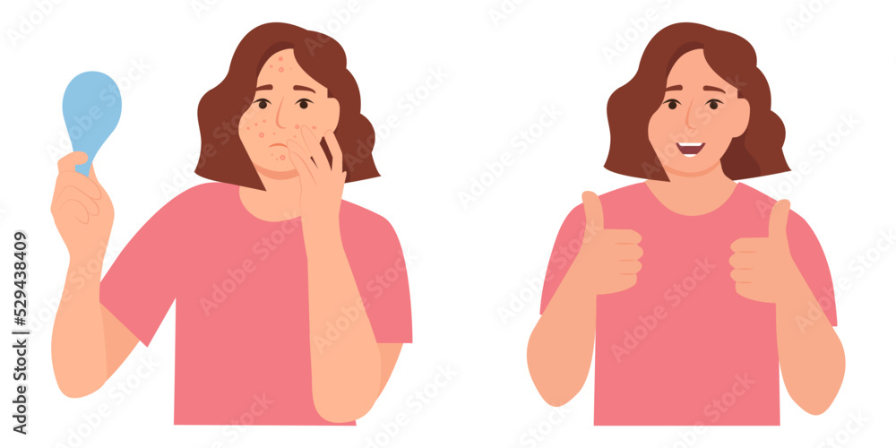 Young girl has problem skin, acne, pimples,blackheads and spots. Before, after. Healthy skin.Skincare and dermatology. Teenage skin. Flat vector illustration Young girl has problem skin, acne, pimples,blackheads and spots. Before, after. Healthy skin.Skincare and dermatology. Teenage skin. Flat vector illustration