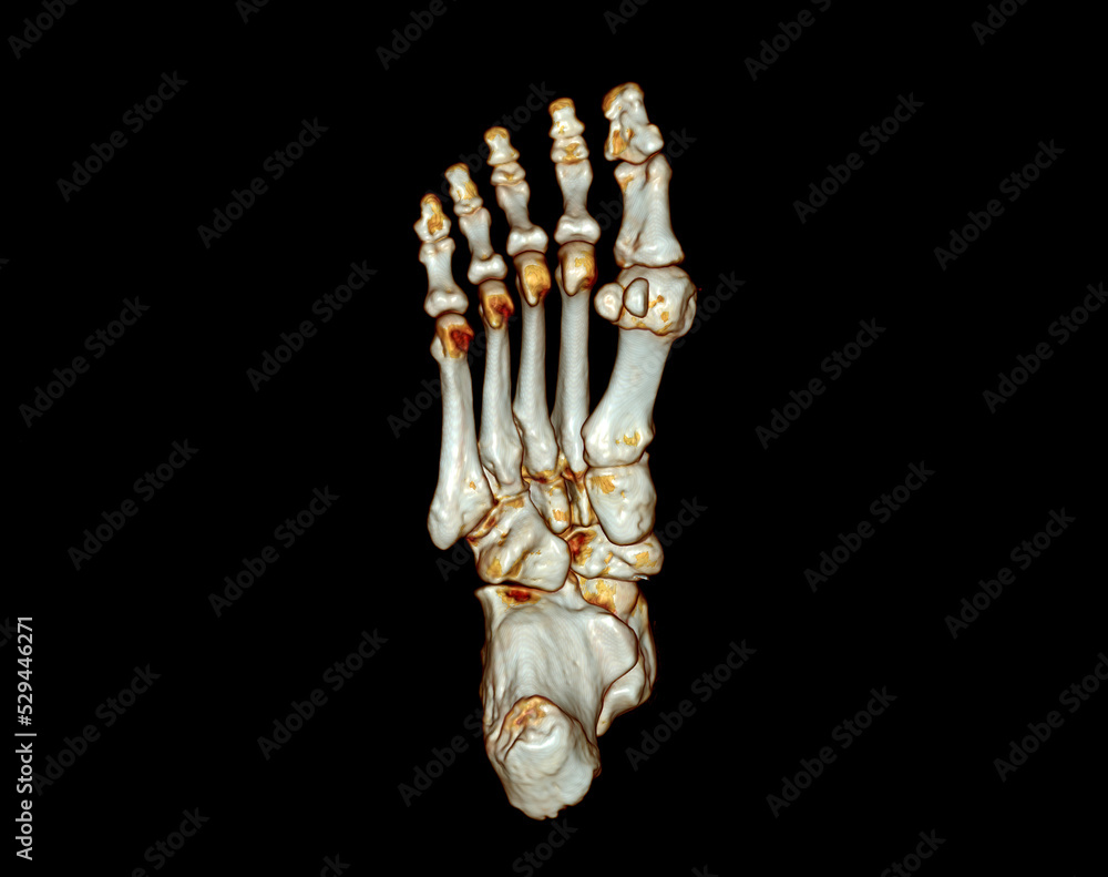 Computed Tomography of the Foot