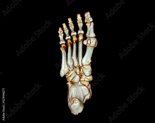 Computed Tomography of the Foot