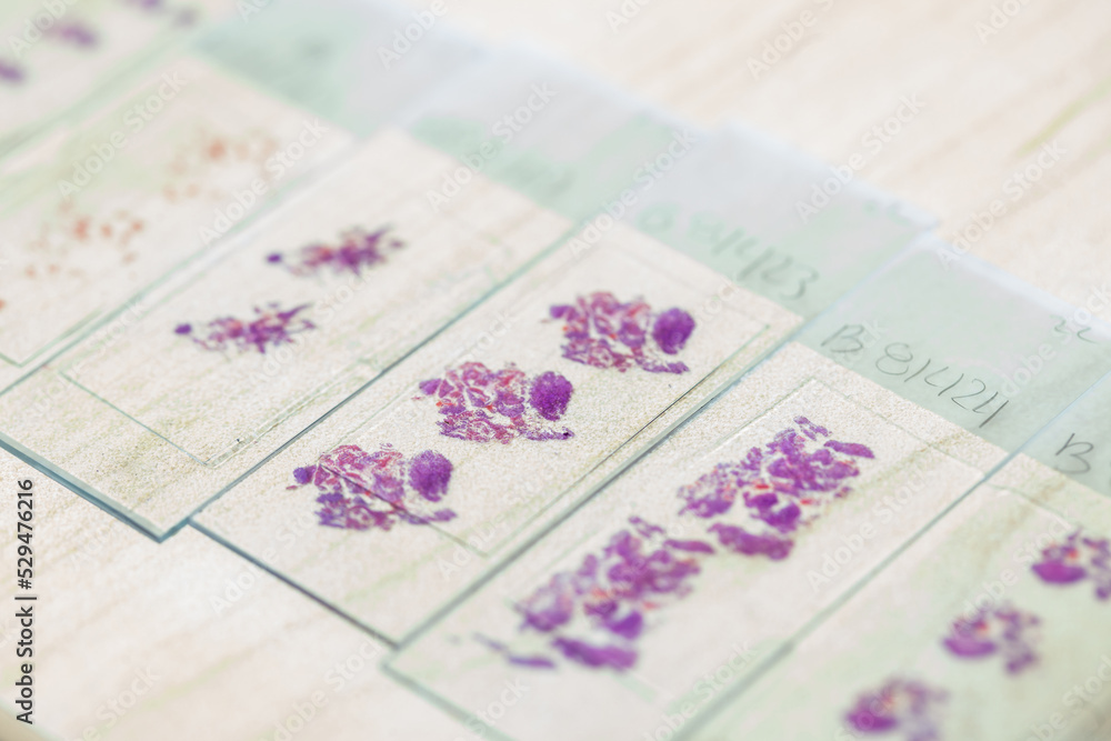 Stained tissue biopsy on glass slides in pathology laboratory Stained tissue biopsy on glass slides in pathology laboratory