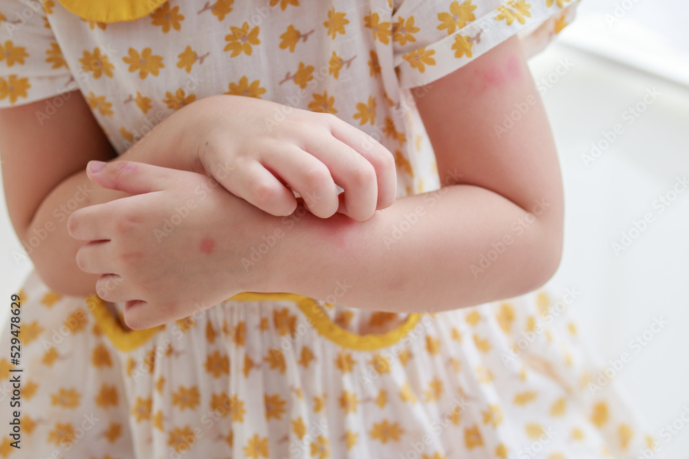 Little girl has skin rash allergy itching and scratching on her arm Little girl has skin rash allergy itching and scratching on her arm