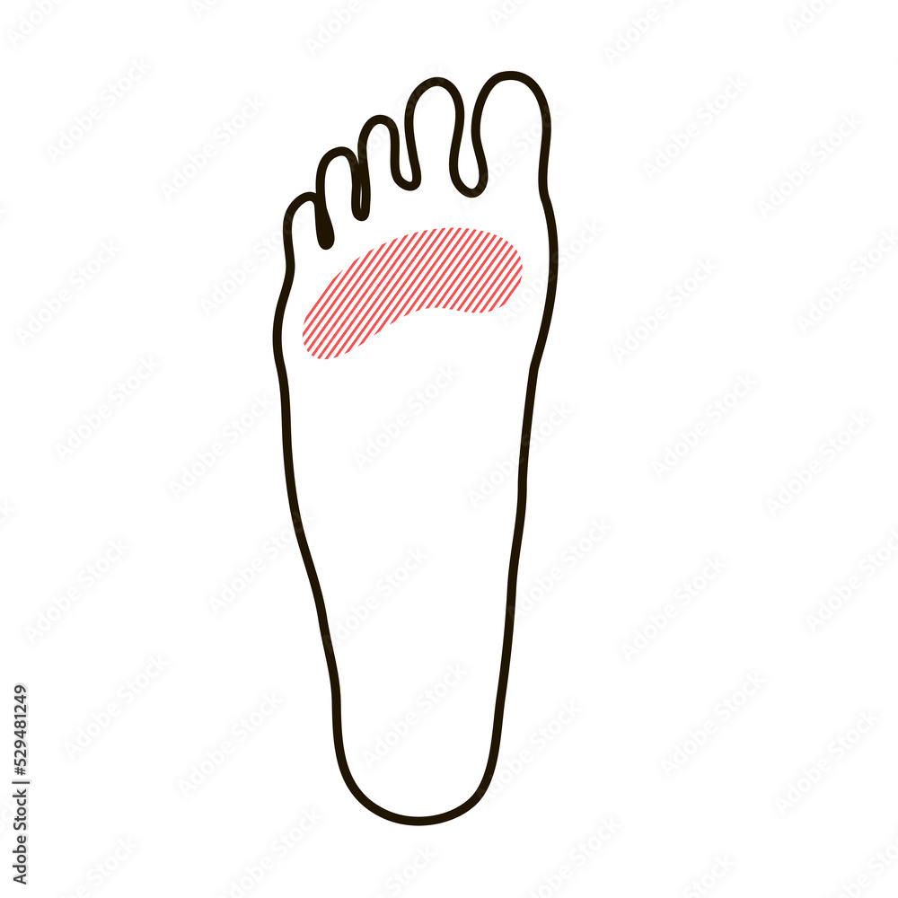 A woman leg with a sore callus. Transverse flat feet. Orthopedic disease. Foot health problems. Vector outline illustration isolated on white background A woman leg with a sore callus. Transverse flat feet. Orthopedic disease. Foot health problems. Vector outline illustration isolated on white background