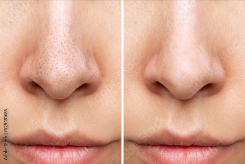 Close-up of woman's nose with blackheads before and after peeling, cleansing the face isolated on a white background. Acne problem, comedones. The result of getting rid of black dots