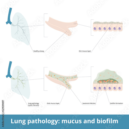 Common lung pathology and excessive mucus. Diseases (cystic fibrosis) may cause the formation of thick mucus in airways, bacterial infection. Biofilm formation in the lungs.