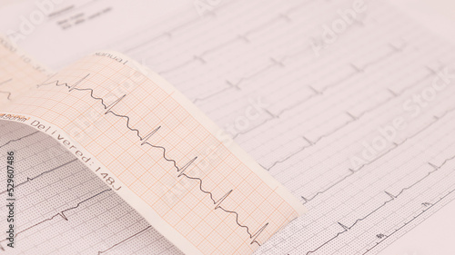 ekg paper showing ECG results on a white background