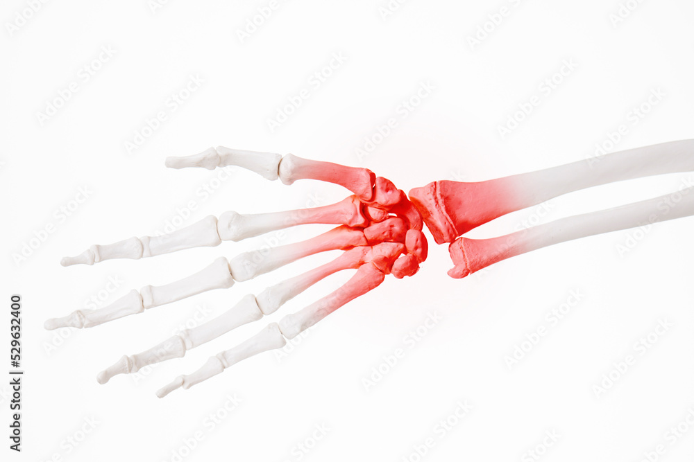 Arthritis of hand joints, rheumatoid nodules of distal radioulnar Stock