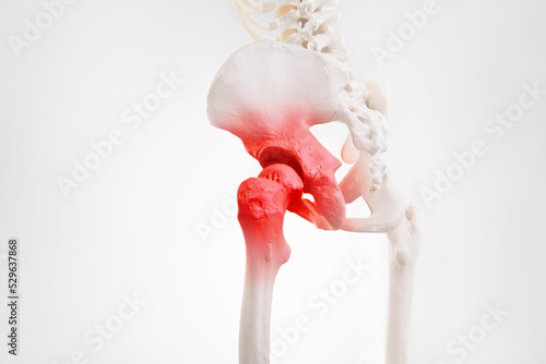 Hip bone pain, human skeleton hip arthritis 