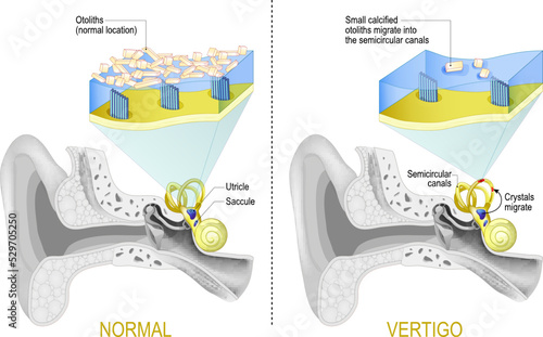 Fotografija Normal vestibular system and Vertigo when Small calcified otoliths migrate from