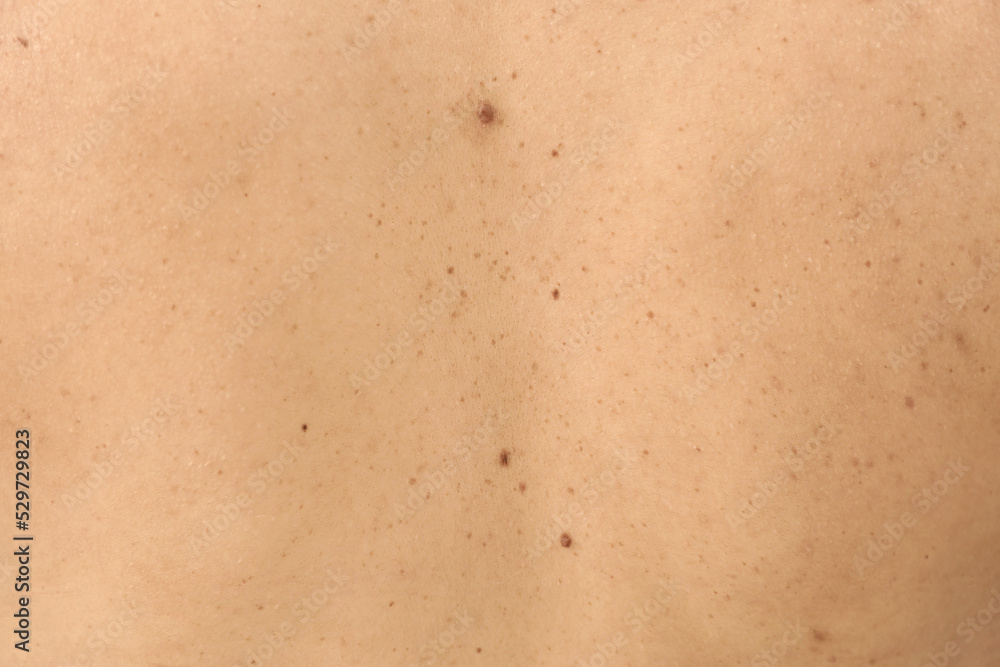 Closeup of woman's body with birthmarks as background Closeup of woman's body with birthmarks as background