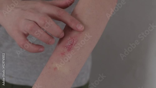 psoriasis en el antebrazo de una mujer, sarpullido escamoso con fisuras lastimadas