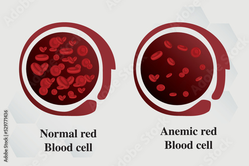 Anemia Iron red blood cell medical vector illustration medical.
