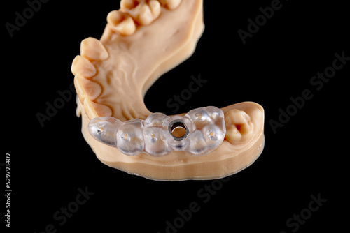 Guide for dental implant