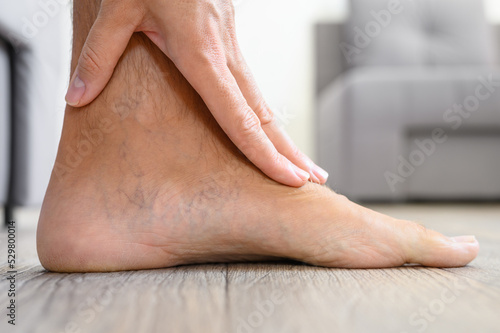 Close-up of varicose veins on the foot of a male leg.