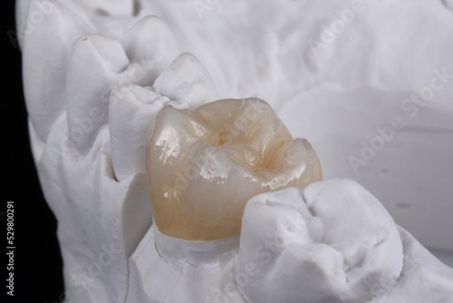 Zirconia crown